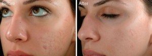 microneedling-before-after-300x112.1