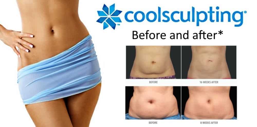 , CoolSculpting limited time offer!